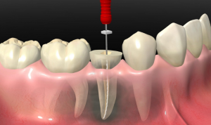 Advanced Root Canal Therapy for Healthy Teeth in Dubai