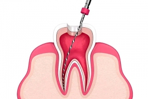 Posterior Root Canal Treatment by Skilled Dubai Dentists