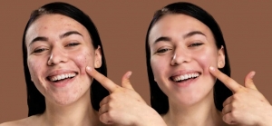 Affordable Pimple Patch Price in Pakistan: Your Ultimate Guide: