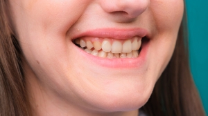 Get Rid of Stubborn Stains with Our Dental Whitening Solutions
