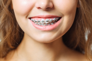 Choosing the Right Orthodontist for Your Metal Braces Treatment