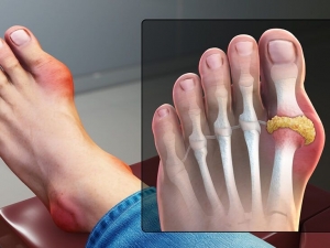 Gout Market Share, Industry Trends, Forecast 2024-34