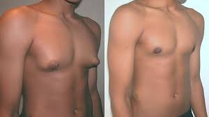 Gynecomastia Surgery: A Comprehensive Guide to Treatment and Recovery
