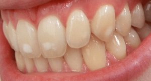 Nano Whitening The Cutting-Edge Smile Solution