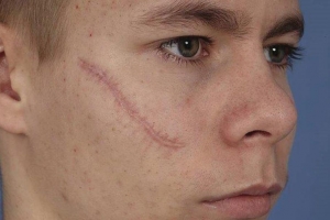 Transform Your Look with Facial Scar Revision 