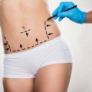 Benefits of Circumferential Abdominoplasty for Residents