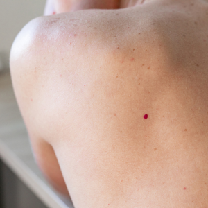 Laser Skin Lesion Removal Services 