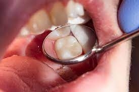 Are Tooth Fillings Safe? Common Concerns and Facts