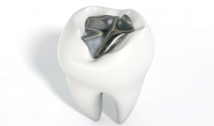 How Fillings Help Keep Your Teeth Strong and Functioning