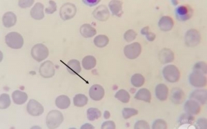 The Future of Gene Therapy for Thalassemia Major in India