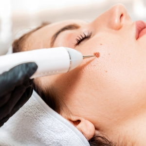 Safe and Effective Mole Removal in Islamabad | Glamorous Clinic