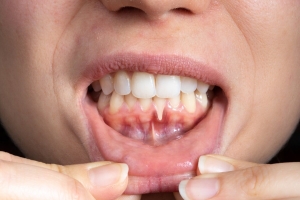 The Science Behind Gum Contouring