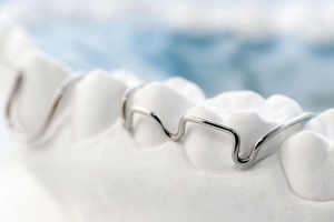 Why I Stopped Wearing My Retainer and Regret It