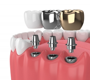 The Truth Behind the Myths About Dental Implants