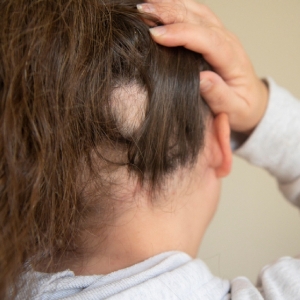 What Are the Benefits of Alopecia Areata Treatments?