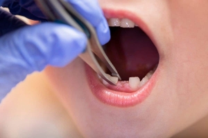 Post-Extraction Care How to Heal Faster After a Dental Extraction