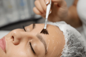 Say Goodbye to Acne Scars with Chemical Peels
