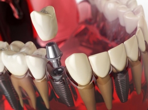 Discover the Best Dental Implants in Lahore at Dr. Imran’s Multispeciality Dental Care
