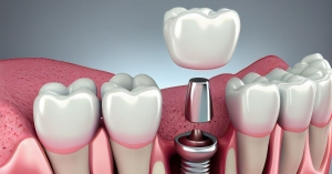 How Dental Implants Restore More Than Just Your Smile