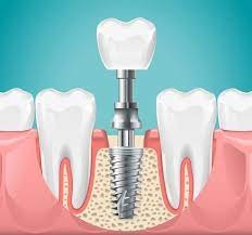 Fast-Track Your Smile with Same-Day Dental Implants