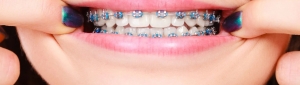 Managing Discomfort and Pain with Metal Braces: Helpful Advice