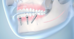 The Psychological Benefits of Dental Implants in Islamabad