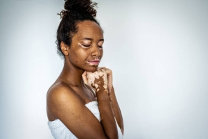 Homeopathy and Vitiligo: Safe and Gentle Solutions for Skin Restoration
