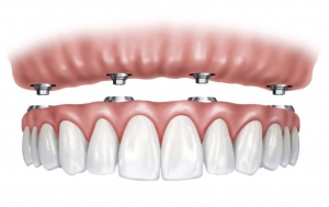 Tips for Preventing Infection After Dental Implant Placement