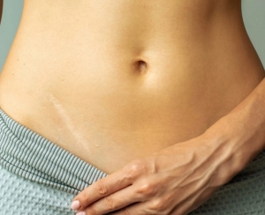 Say Goodbye to Scars with Advanced Laser Treatment at Glamorous Clinic