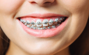Say Goodbye to Crooked Teeth with Dental Braces