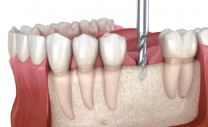 Caring for Your Dental Implants: Tips for Long-Lasting Results