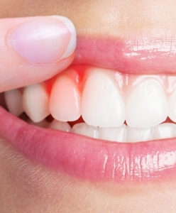 Gum Contouring for a More Youthful Appearance