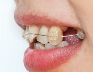 Crooked Teeth No More, Explore Your Treatment Choices