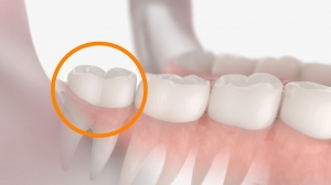 What Are the Signs That I Need My Wisdom Teeth Taken Out?