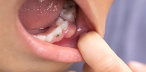 How Fillings Can Improve Your Oral Health