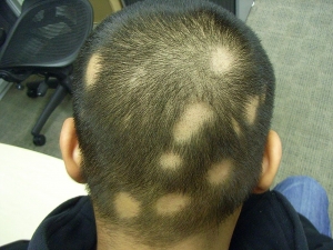 Reviews of Top Alopecia Areata Clinics in Islamabad: What You Need to Know