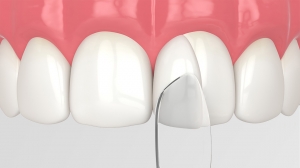 Dental Bonding Cement, A Reliable Solution for Filling Gaps