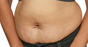 Why Fat Melting Injections Are an Effective Solution for Post-Baby Fat