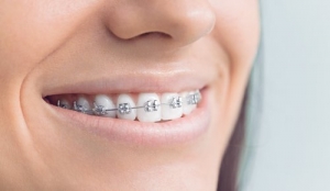 A Beginner’s Guide to Metal Braces