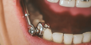 Keep Your Teeth Healthy with Protective Dental Appliances