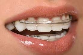 Keeping Your Teeth in Place with Retainers