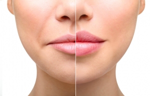 Benefits of Hyaluronic Acid Fillers for Lip Augmentation in Islamabad