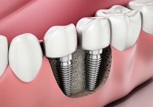 From Consultation to Completion: The Same-Day Dental Implants Process