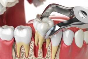 The Truth About Tooth Removal, Is It Always Necessary?