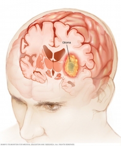 Glioma Market Report 2024-2034 | Industry Size, Growth and Latest Insights