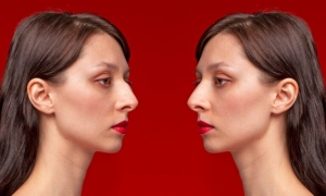 How Rhinoplasty Can Improve Both Appearance and Breathing
