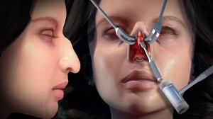 Iconic Transformations: The Best Celebrity Nose Jobs Revealed