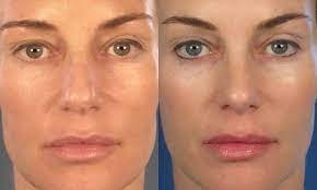 Solutions for a Bulbous Tip: Personalized Nose Job Techniques