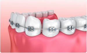 Braces Without Breaking the Bank: Understanding Dental Braces Cost in Gurgaon