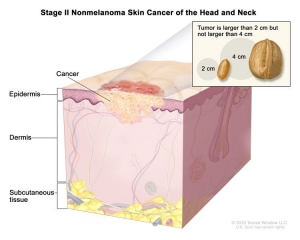 Nonmelanoma Skin Cancer Market Share, Industry Trends, Forecast 2024-34
